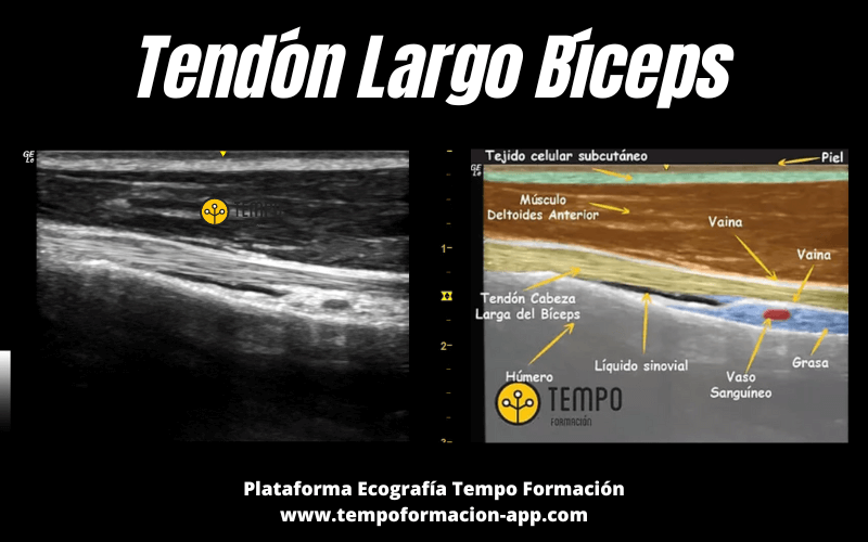 Tendón Largo Bíceps Ecografía Aprende A Valorarlo Tempo Formación